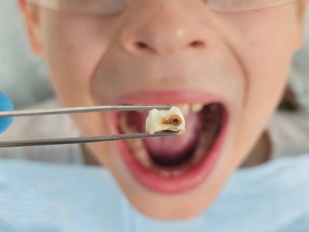 Best Emergency Dental Care for Broken or Chipped Teeth in Wrens, GA